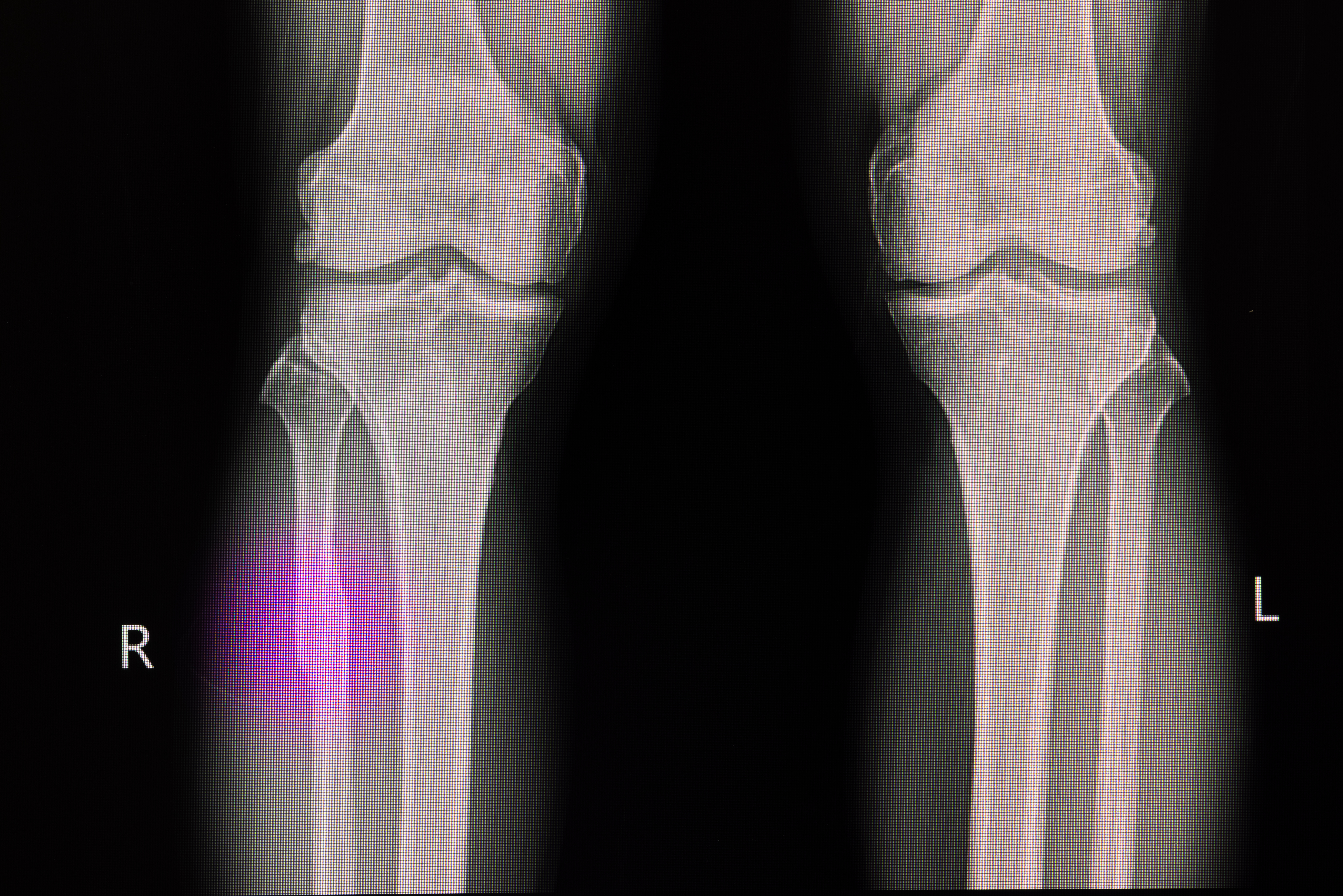 X -ray film of a knee of a patient with fractured proximal fibul