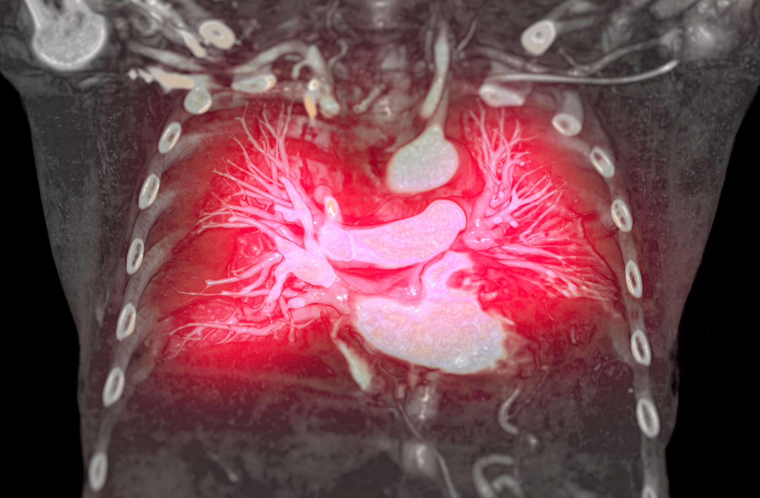 CTA pulmonary arteries 3D rendering showing branch of pulmonary