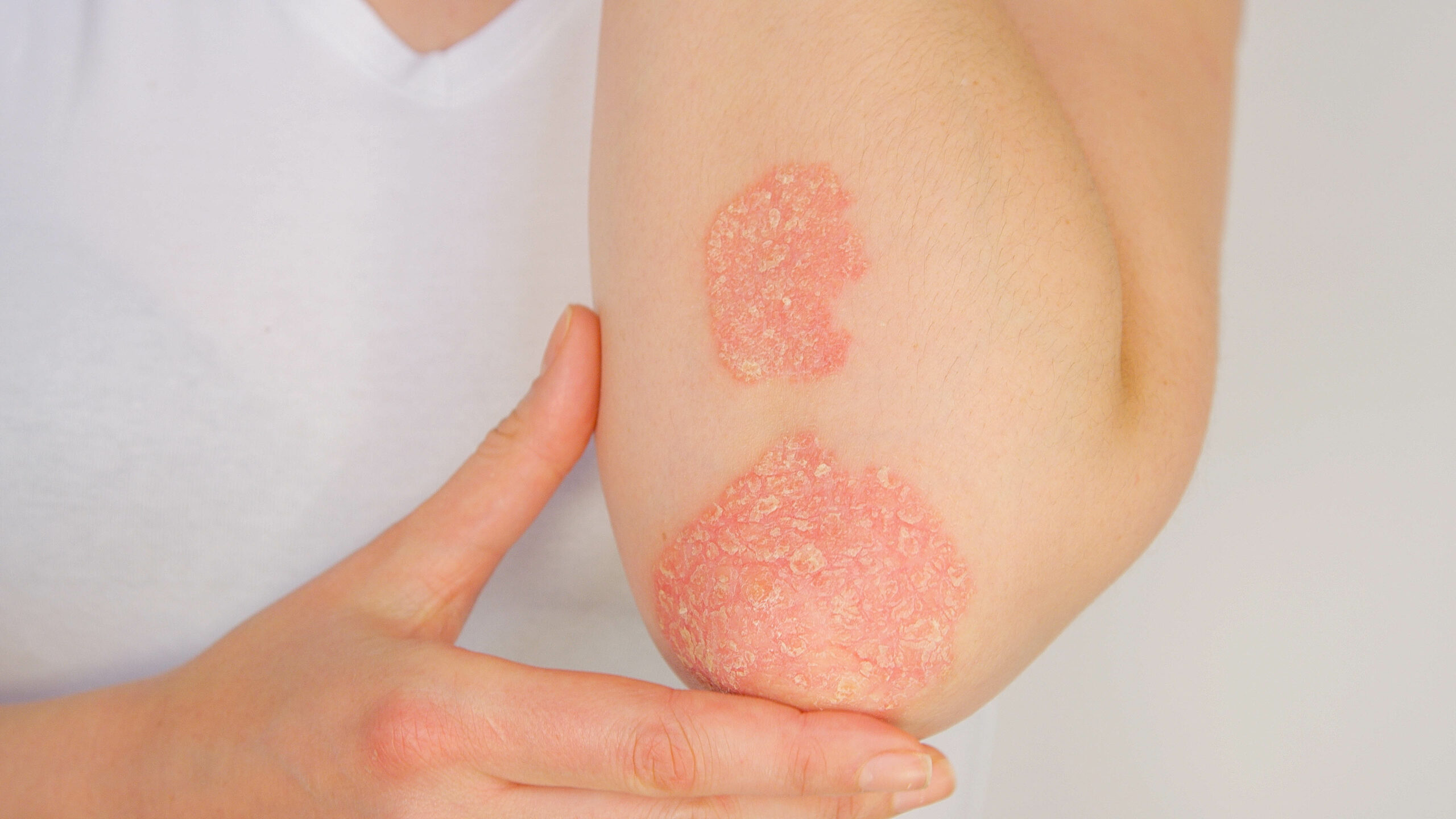 CLOSE UP Woman with big red scaly rash suffering from elbow psor