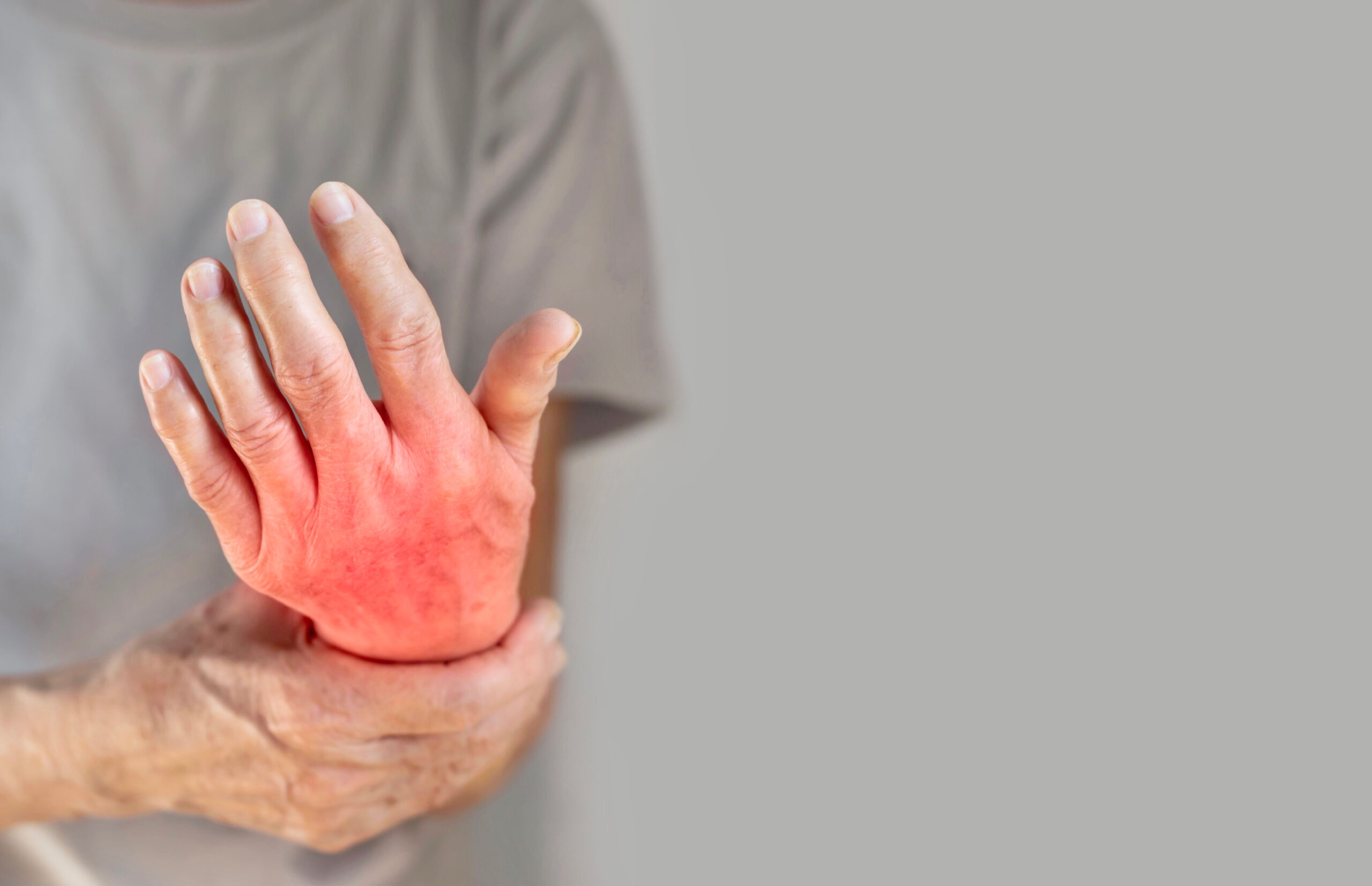 Hand joints inflammation. Concept of rheumatic arthritis, rheuma