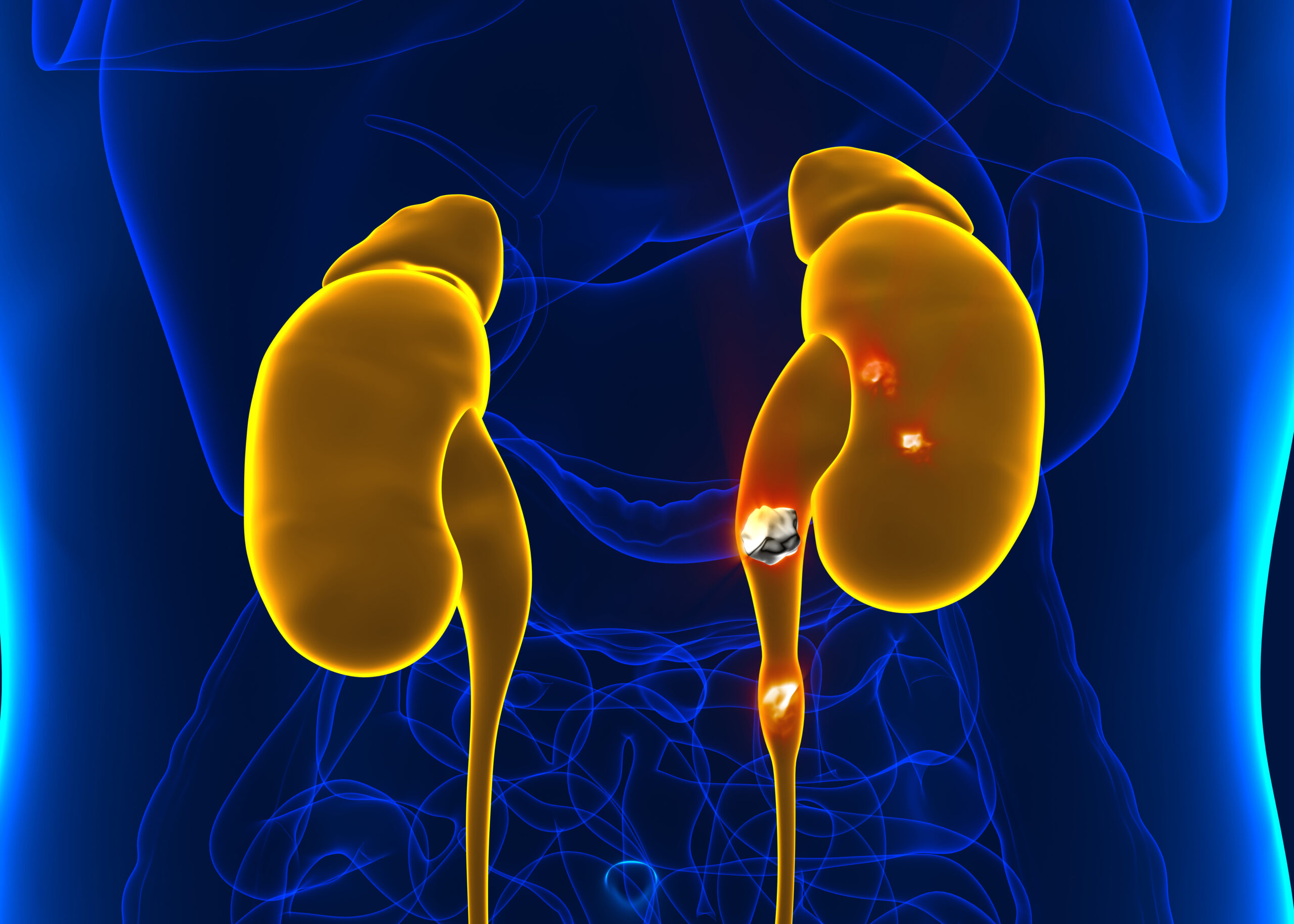 Kidney stones anatomy pain male internal organ painful cristaline mineral cross section – 3d illustration