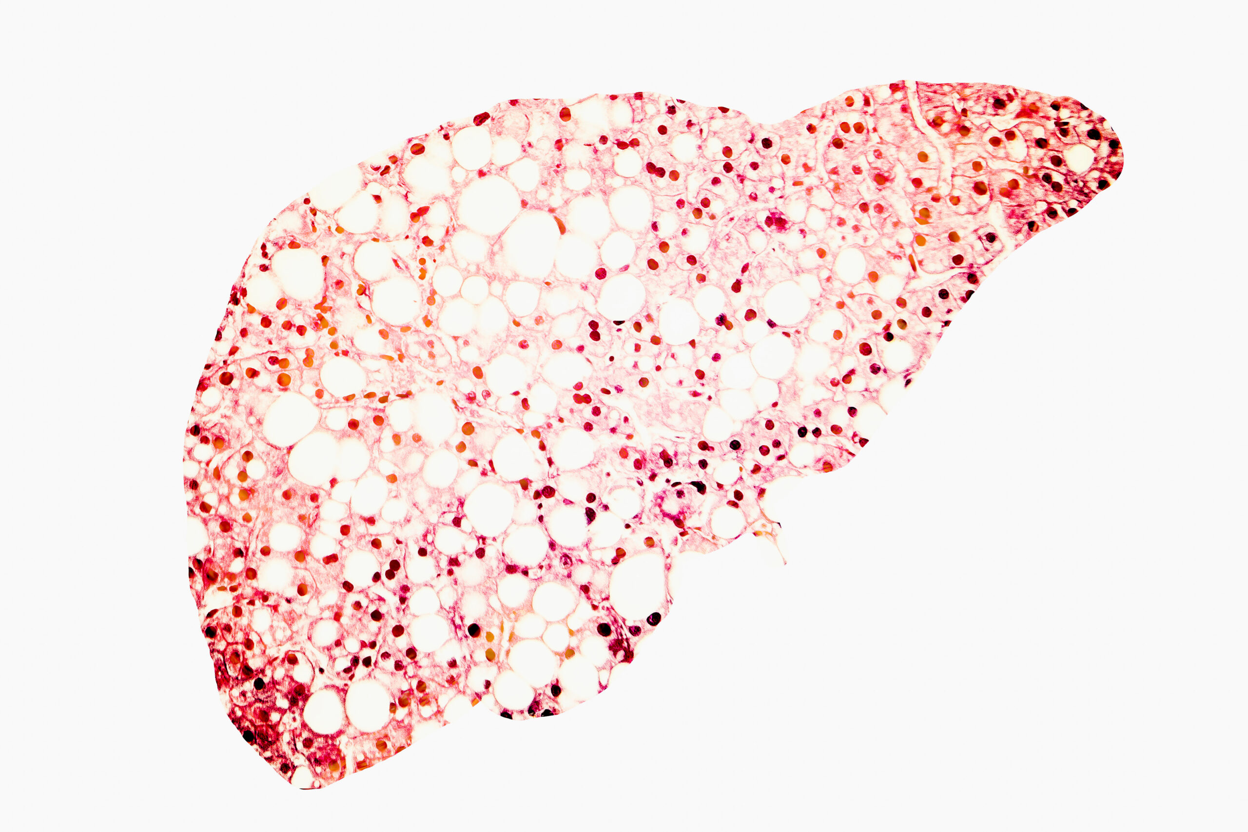 Fatty liver conceptual image
