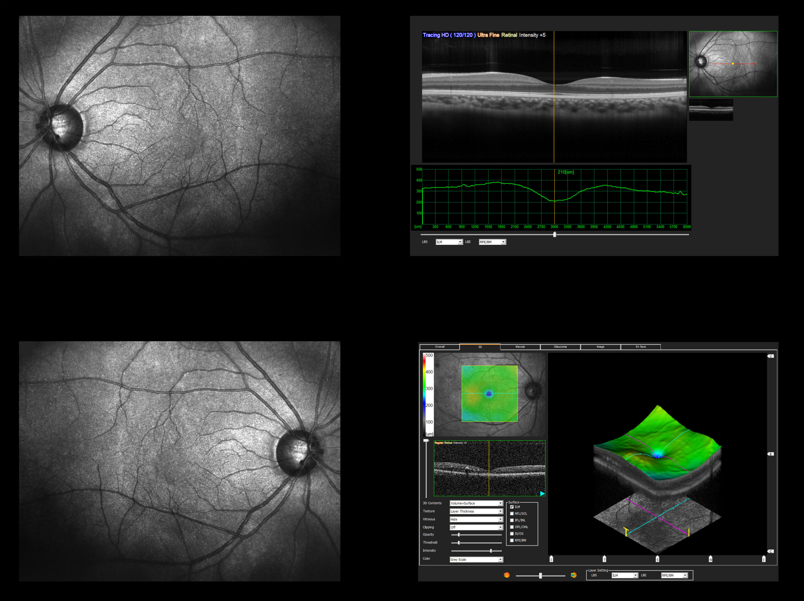 Ophthalmic test – OCT optical coherence tomography measurement. Scan of the macula in retina, layers and thickness of retina.