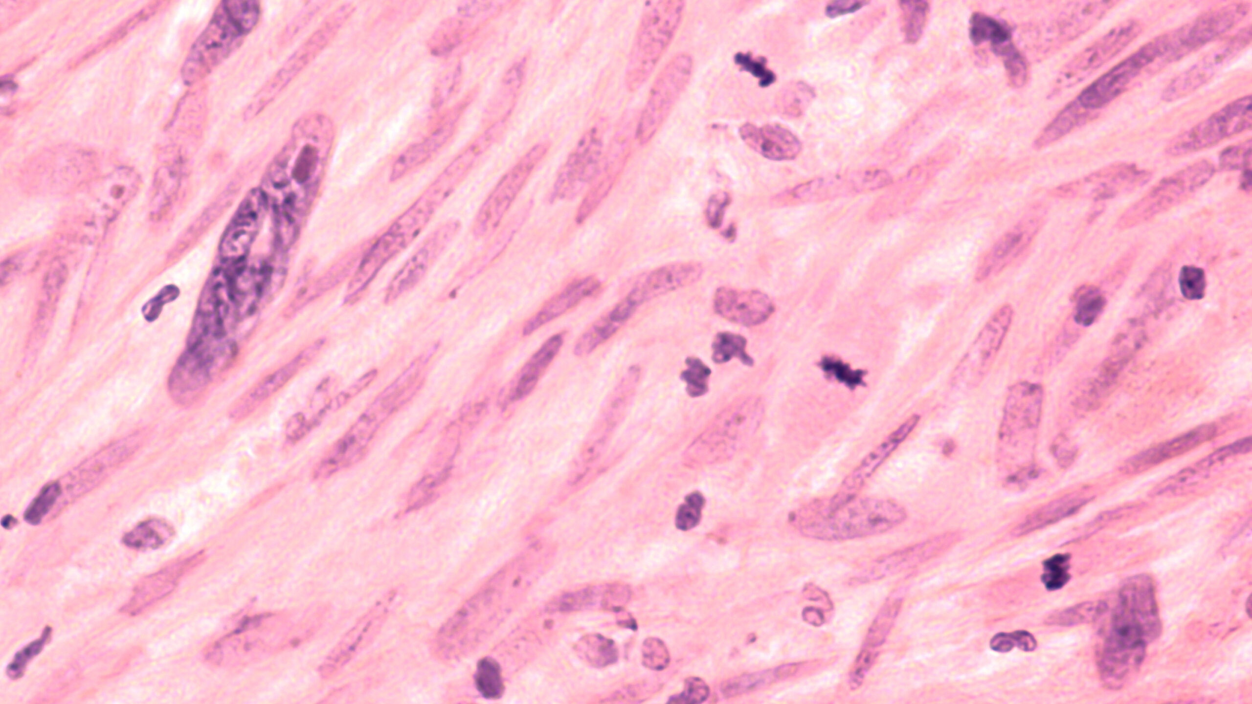 Microscopic image of a leiomyosarcoma, a type of soft tissue sarcoma of smooth muscle.  This malignant tumor typically occurs in the uterus or GI tract, but can occur from blood vessels elsewhere.