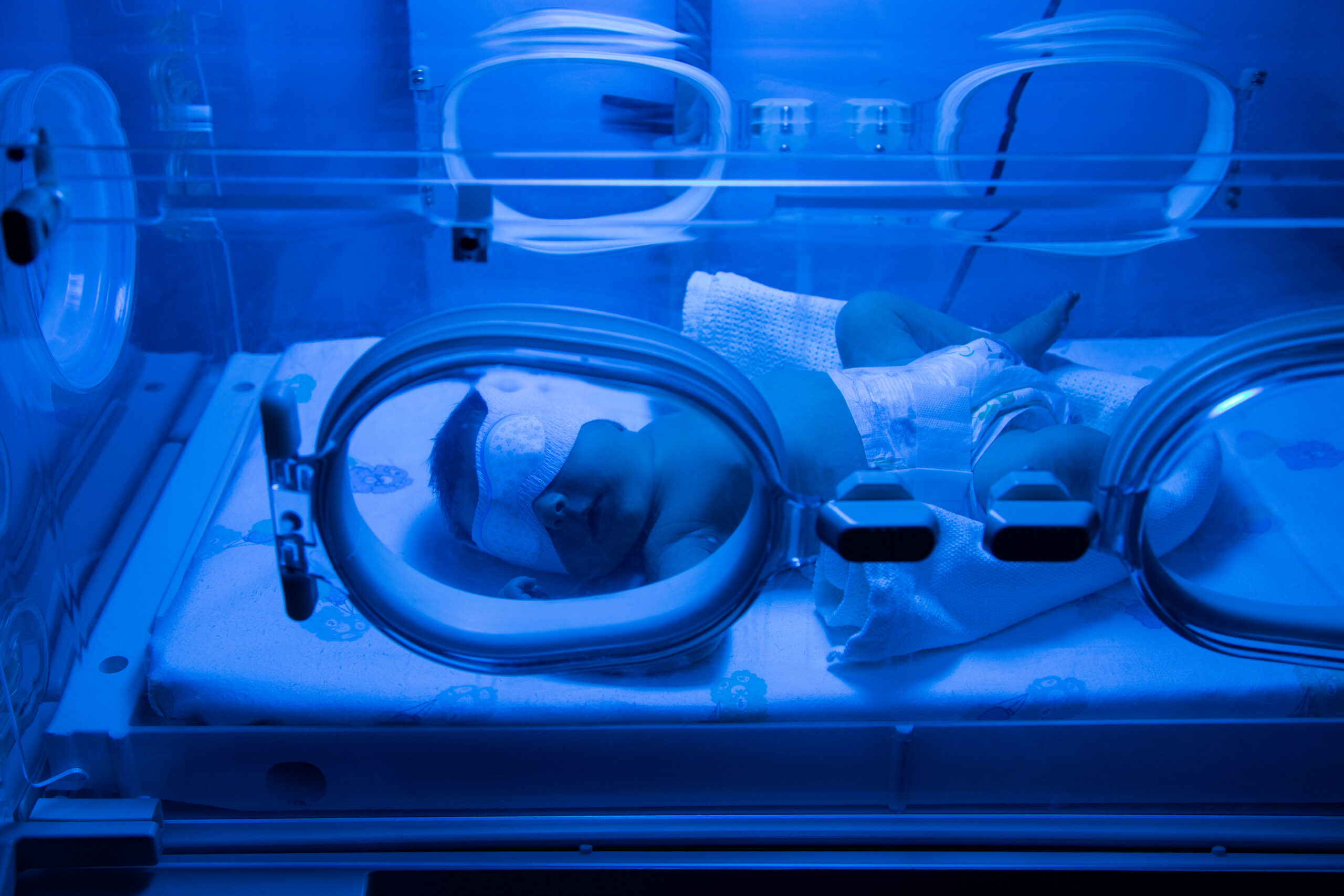 Newborn Baby having UVB phototherapy treatment for jaundice