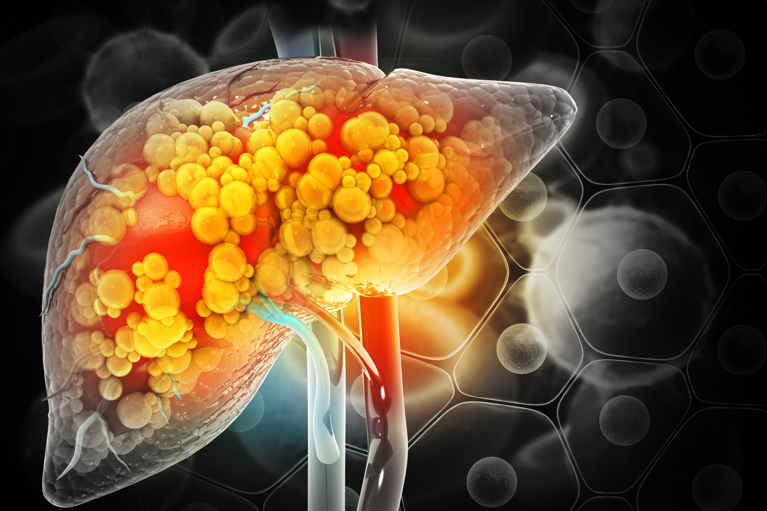 Liver damage such as Fatty liver, Fibrosis, Cirrhosis, and Liver cancer. 3d illustration