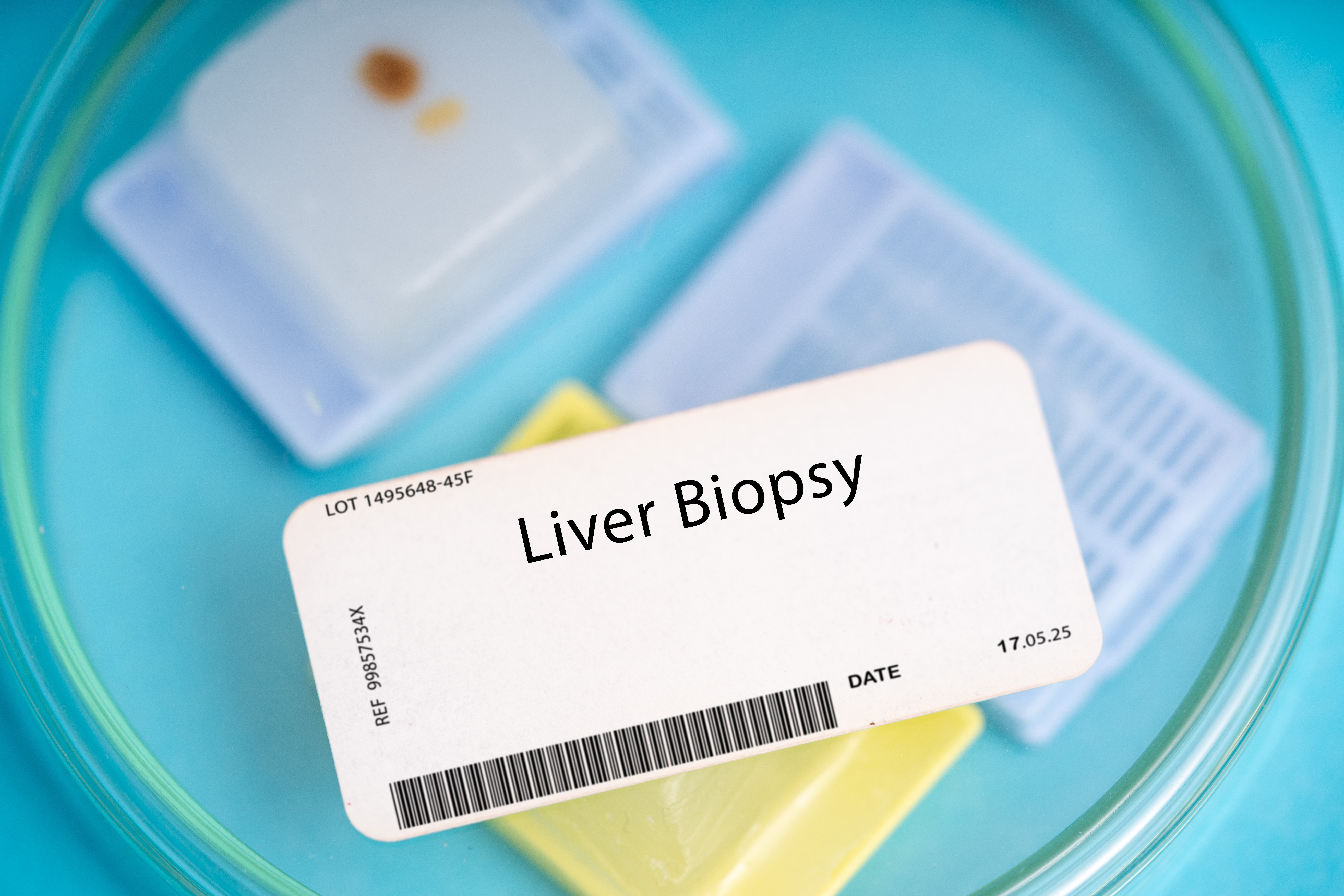 Liver biopsy. A small piece of liver tissue to evaluate for conditions such as cirrhosis, hepatitis, or liver cancer.