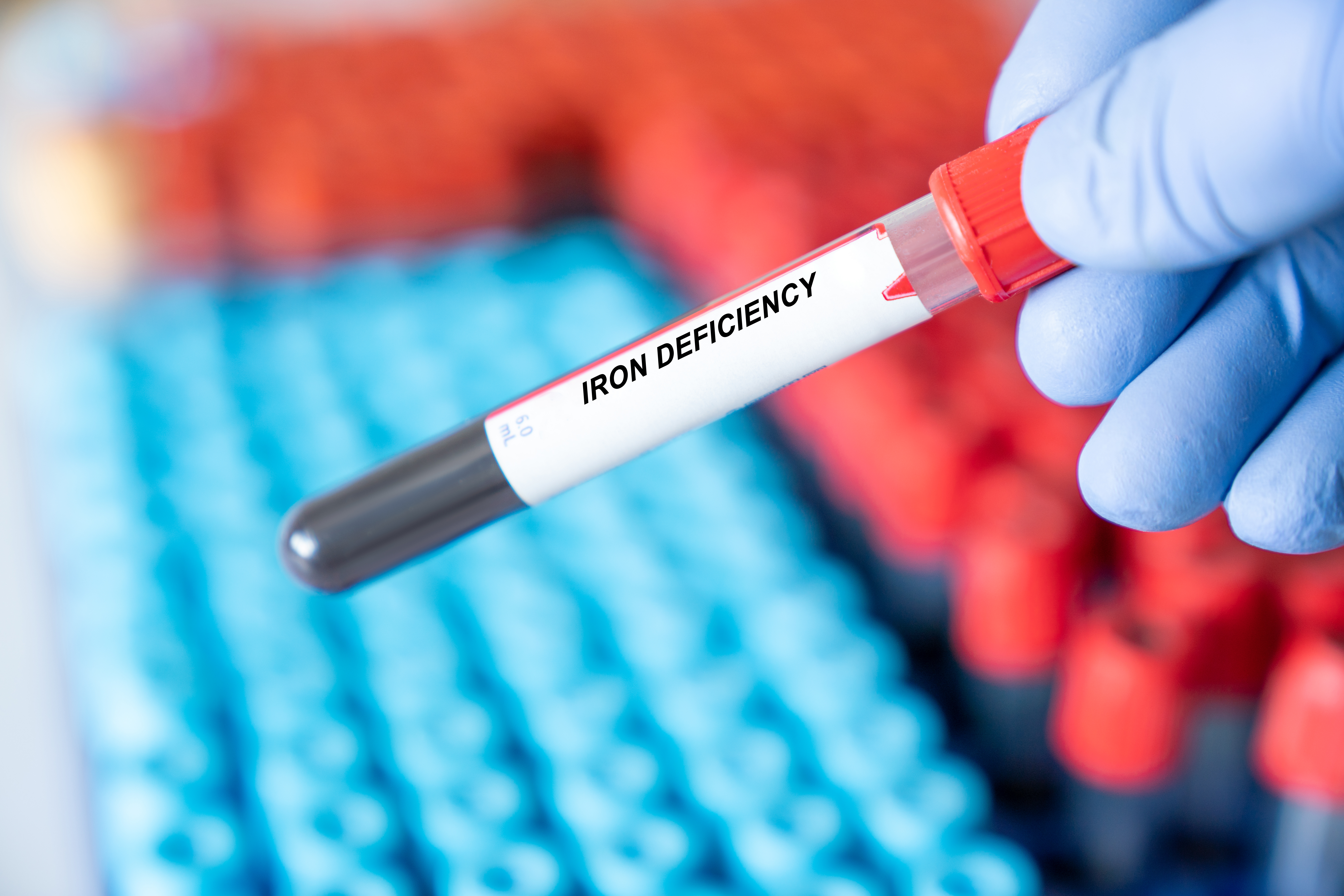 Iron Deficiency. Iron Deficiency disease blood test inmedical laboratory