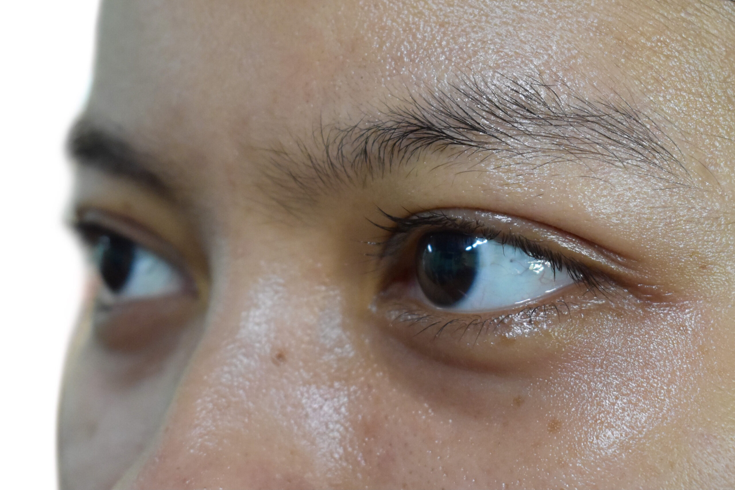 Dark circles around eyes of Asian woman. Brown discoloration of eyelids.