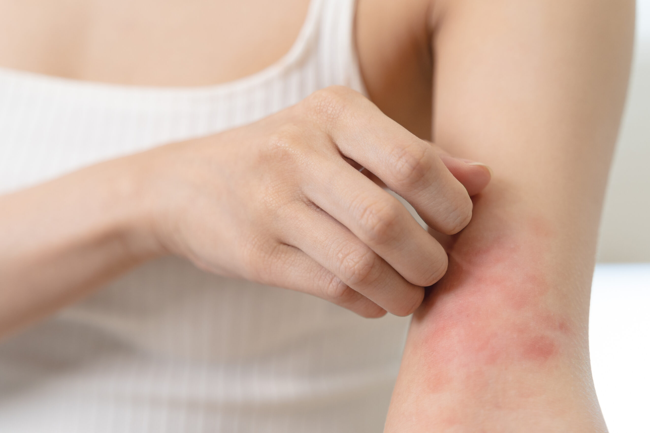 Sensitive skin allergic concept, Woman itching on her arm have a